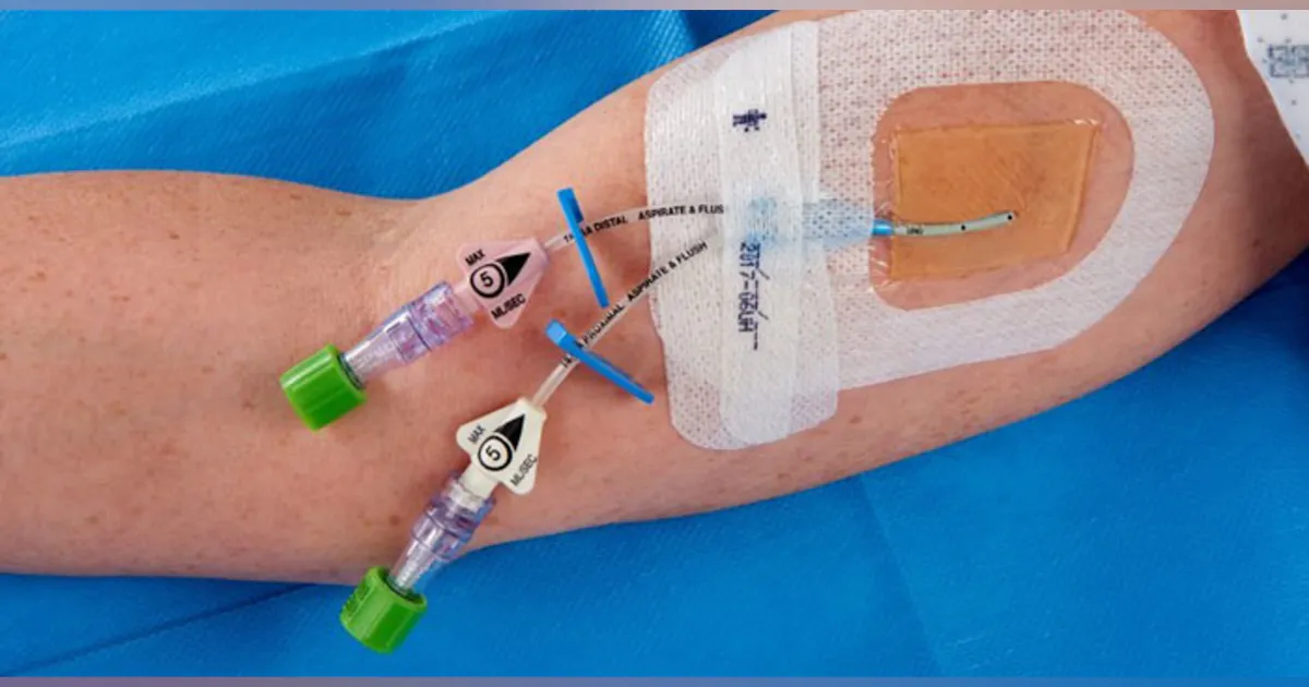 Catheter-care trifecta: compliant, cost-effective, innovative | HPN Online Catheter-care trifecta: compliant, cost-effective, innovative | HPN Online