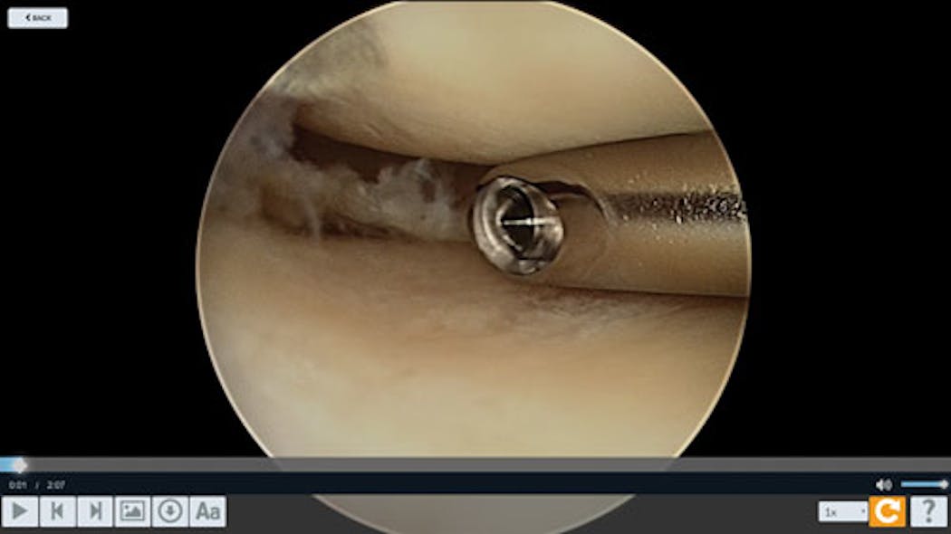 Ip Image Stream Knee Arthroscopy
