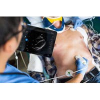 Phillips Lumify S4 1 Subcostal Phillips Lumify S4 1 Subcostal