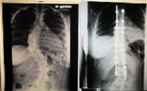 Before and After xrays