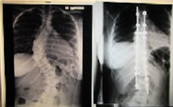 Before and After xrays Before and After xrays