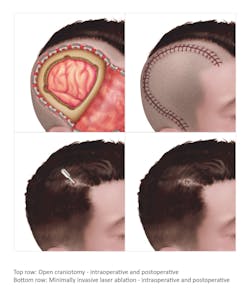 Monteris 1 Monteris 1