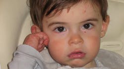 Jackson has recessive dystrophic epidermolysis bullosa, a painful and incurable blistering disorder. Jackson has recessive dystrophic epidermolysis bullosa, a painful and incurable blistering disorder.