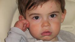 Jackson has recessive dystrophic epidermolysis bullosa, a painful and incurable blistering disorder.