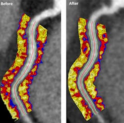 Coronary CT angiography image of the coronary arteries depicting the perivascular fat attenuation index before and after biologic therapy at one-year follow-up for patients with excellent response to biologic therapy. Coronary CT angiography image of the coronary arteries depicting the perivascular fat attenuation index before and after biologic therapy at one-year follow-up for patients with excellent response to biologic therapy.