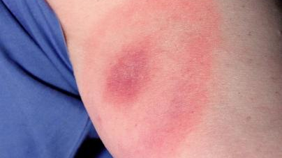 Erythema migrans &mdash; the tell-tale bull's-eye rash &mdash; appears on 70 percent to 80 percent of patients. James Gathany/CDC