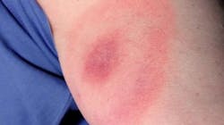 Erythema migrans — the tell-tale bull's-eye rash — appears on 70 percent to 80 percent of patients. James Gathany/CDC Erythema migrans — the tell-tale bull's-eye rash — appears on 70 percent to 80 percent of patients. James Gathany/CDC