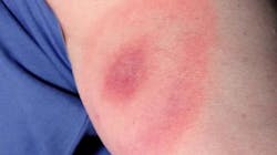 Erythema migrans &mdash; the tell-tale bull&apos;s-eye rash &mdash; appears on 70 percent to 80 percent of patients. James Gathany/CDC