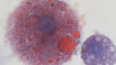 Lipid-laden macrophages found in lungs of vaping patients. Credit Andrew Hansen, MD, Jordan Valley Medical Center.