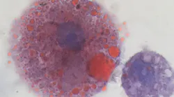 Lipid-laden macrophages found in lungs of vaping patients. Credit Andrew Hansen, MD, Jordan Valley Medical Center.