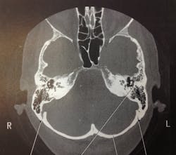 Ut Health Simple And Advanced Ct Imaging Stroke Thrombectomy Pic 1 24 20du 8147030031 064d36e7d0 O Flickr Fda 5e2afeb16072c Ut Health Simple And Advanced Ct Imaging Stroke Thrombectomy Pic 1 24 20du 8147030031 064d36e7d0 O Flickr Fda 5e2afeb16072c