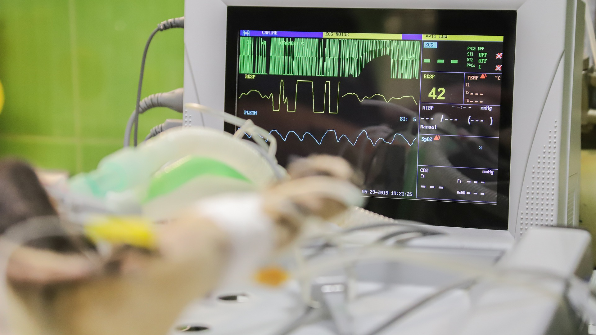 Heart Surgery Stalled In Covid 19 Pic 6 3 20du Monitoring 4939621 1920 Pixabay 5ed7baa5e9727