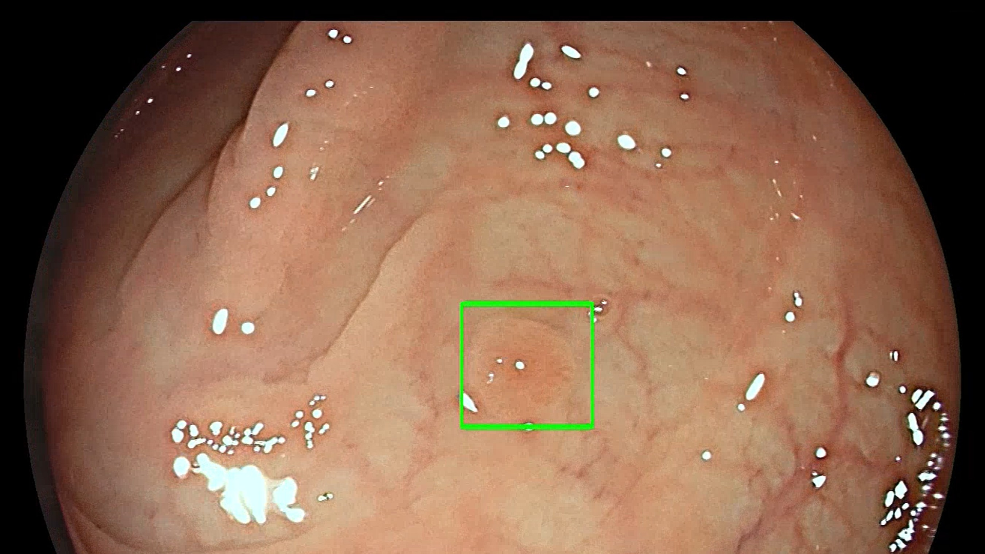 Photo courtesy of Medtronic