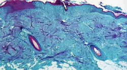 CDC and Texas confirm monkeypox In U.S. traveler