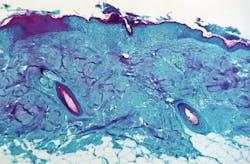 CDC and Texas confirm monkeypox In U.S. traveler CDC and Texas confirm monkeypox In U.S. traveler