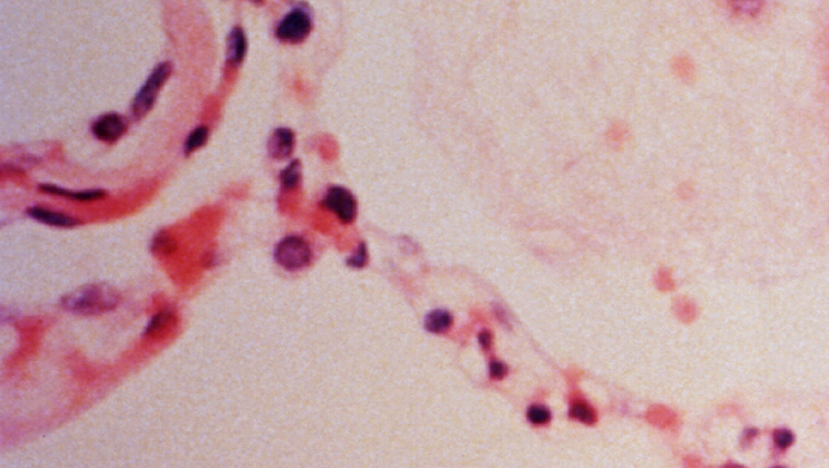 ARDS, Courtesy of CDC.