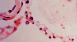 ARDS, Courtesy of CDC.