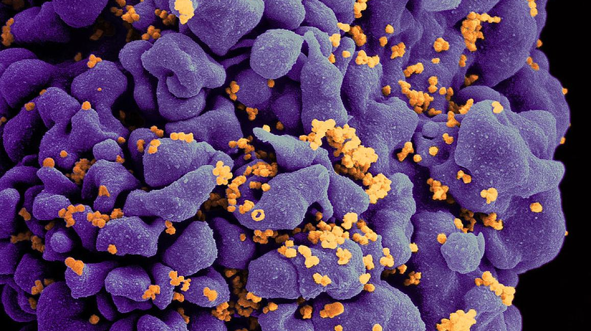 Scanning electron micrograph of an HIV-infected H9 T cell, colorized in Halloween colors. NIAID.