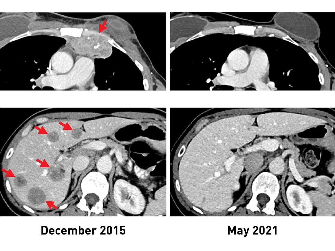 An experimental form of immunotherapy that uses an individual&rsquo;s own tumor-fighting immune cells could potentially be used to treat people with metastatic breast cancer, according to results from an ongoing clinical trial led by researchers at the National Cancer Institute&rsquo;s (NCI) Center for Cancer Research, part of the National Institutes of Health.