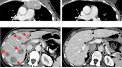 An experimental form of immunotherapy that uses an individual’s own tumor-fighting immune cells could potentially be used to treat people with metastatic breast cancer, according to results from an ongoing clinical trial led by researchers at the National Cancer Institute’s (NCI) Center for Cancer Research, part of the National Institutes of Health.
