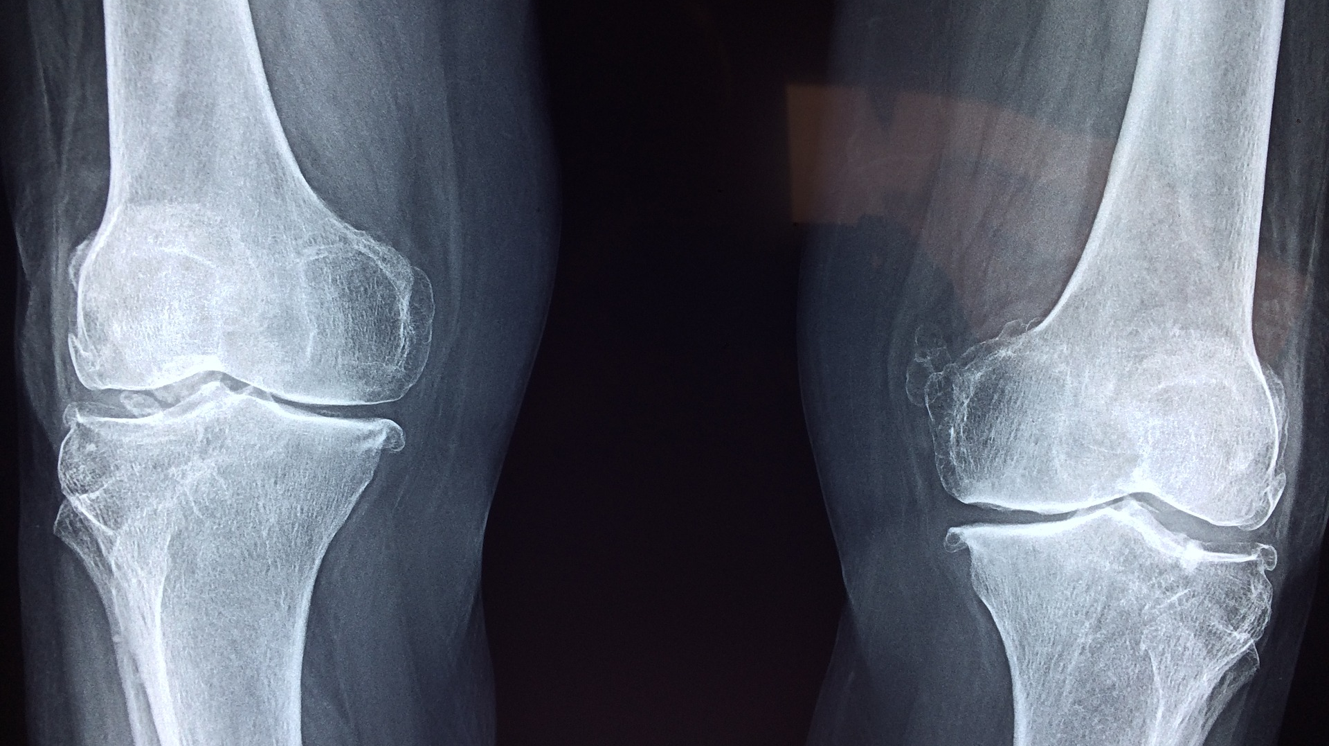 Knee Ge4ec6753c 1920 623b238948557