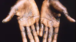 Courtesy of the CDC
