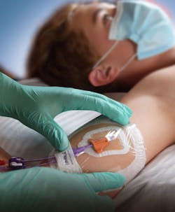 Interrad Secur Acath Device On Picc Line Interrad Secur Acath Device On Picc Line