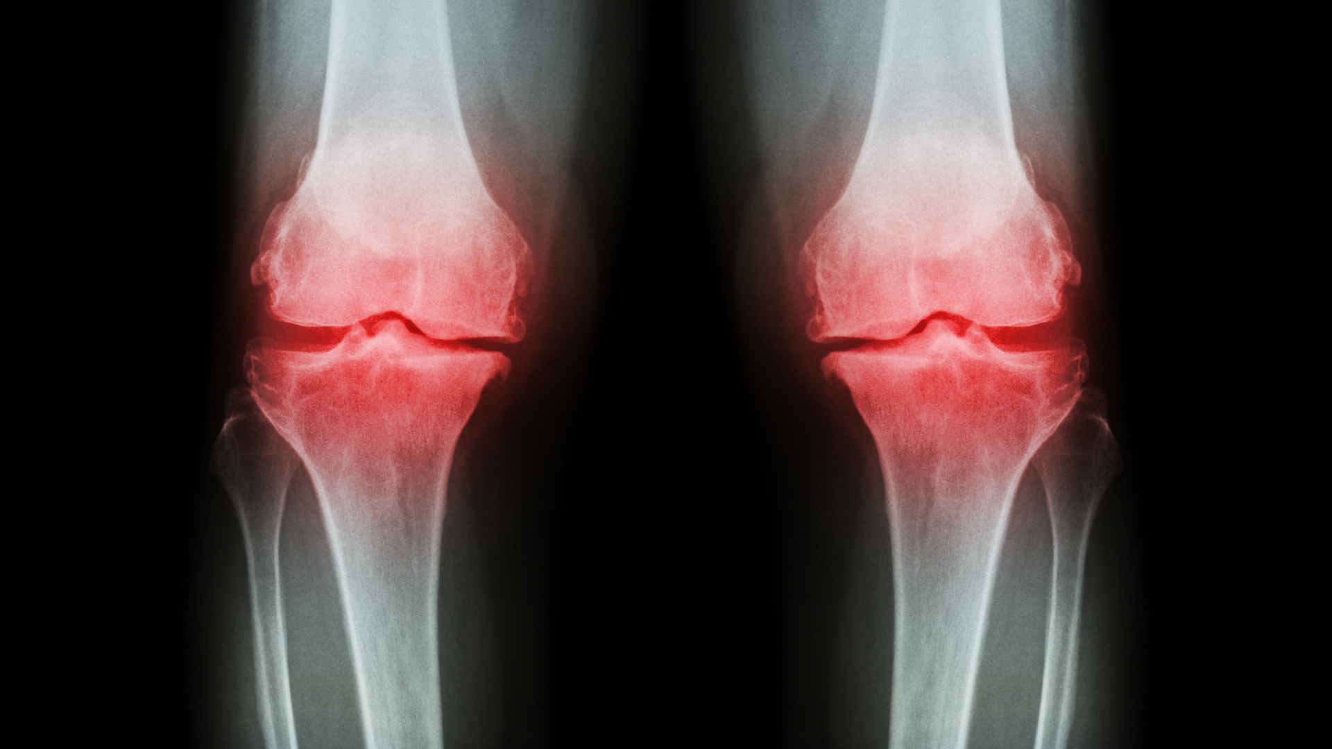 Study shows asthma and eczema linked to osteoarthritis risk