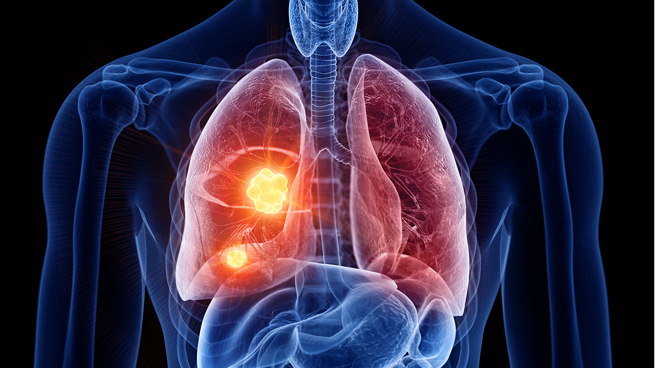 Lung Cancer
