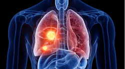 Lung Cancer