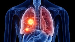 Lung Cancer 64a6daf3cc1fe Lung Cancer 64a6daf3cc1fe