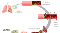 sepsis