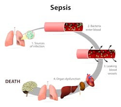 660d87c0829202001e083157 Sepsis 660d87c0829202001e083157 Sepsis