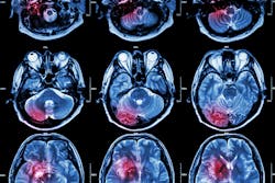 6719152be1f9fb8f1b2d1a7c Tumor 6719152be1f9fb8f1b2d1a7c Tumor