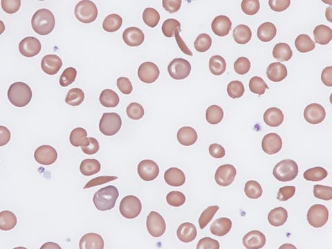 67bdee72ec23a557aed376e9 Sickle Cell