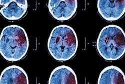 67dae4a564965c670da31eb0 Stroke 67dae4a564965c670da31eb0 Stroke