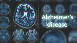 682b5530d96b8f7aeccf439a Alzheimers 2