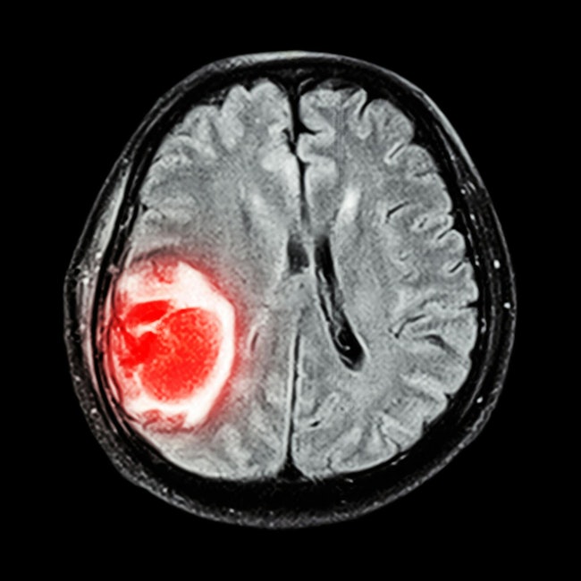 68bb1659dbb6a90ec732b247 Brain Tumor 2