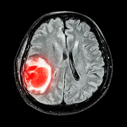 68bb1659dbb6a90ec732b247 Brain Tumor 2 68bb1659dbb6a90ec732b247 Brain Tumor 2