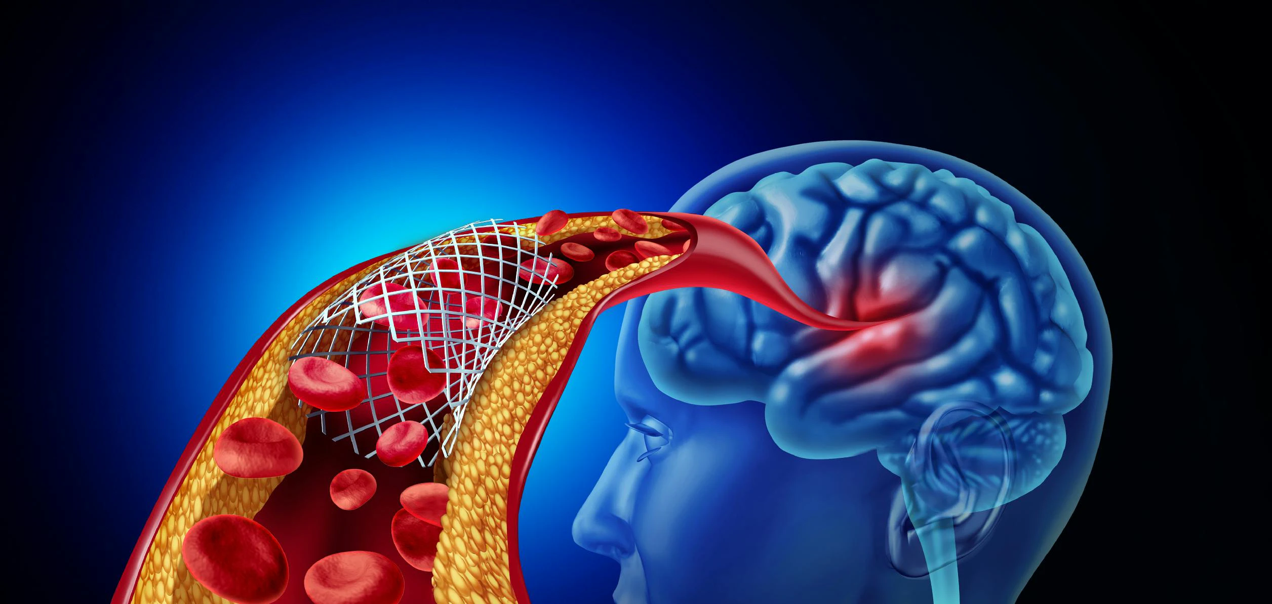 69b4202ce3b269c5062f4db3 Neurovascular Stent