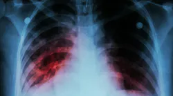 tuberculosis_3