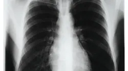 pneumonia