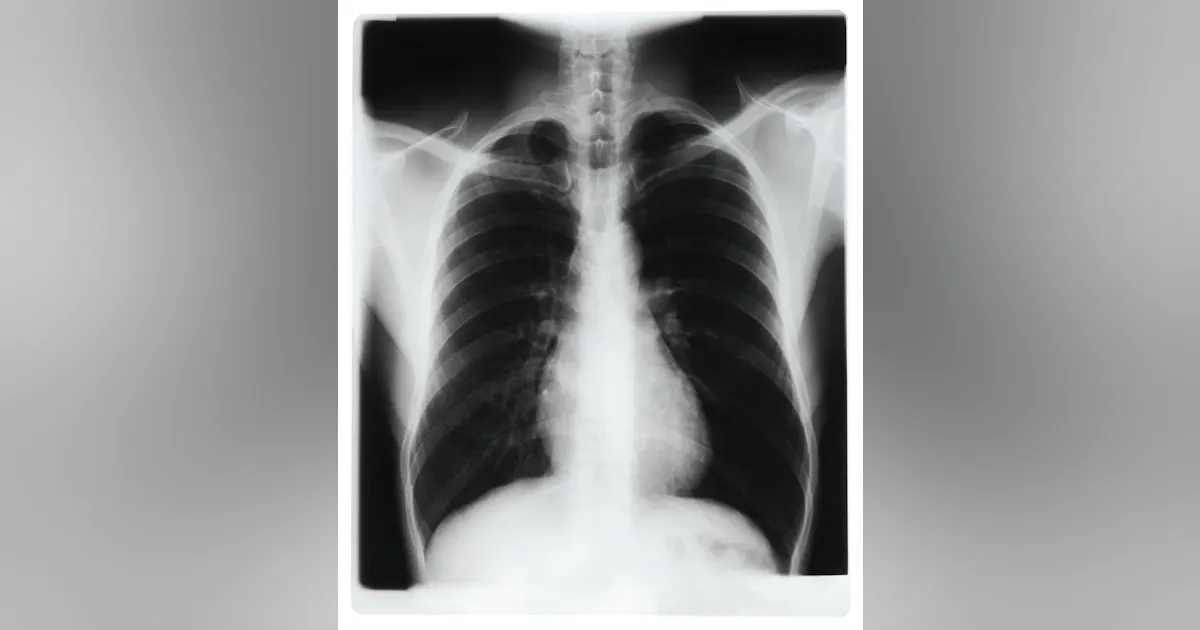 Some Pneumonia Patients See Benefit from Shorter Antibiotic Treatment ...