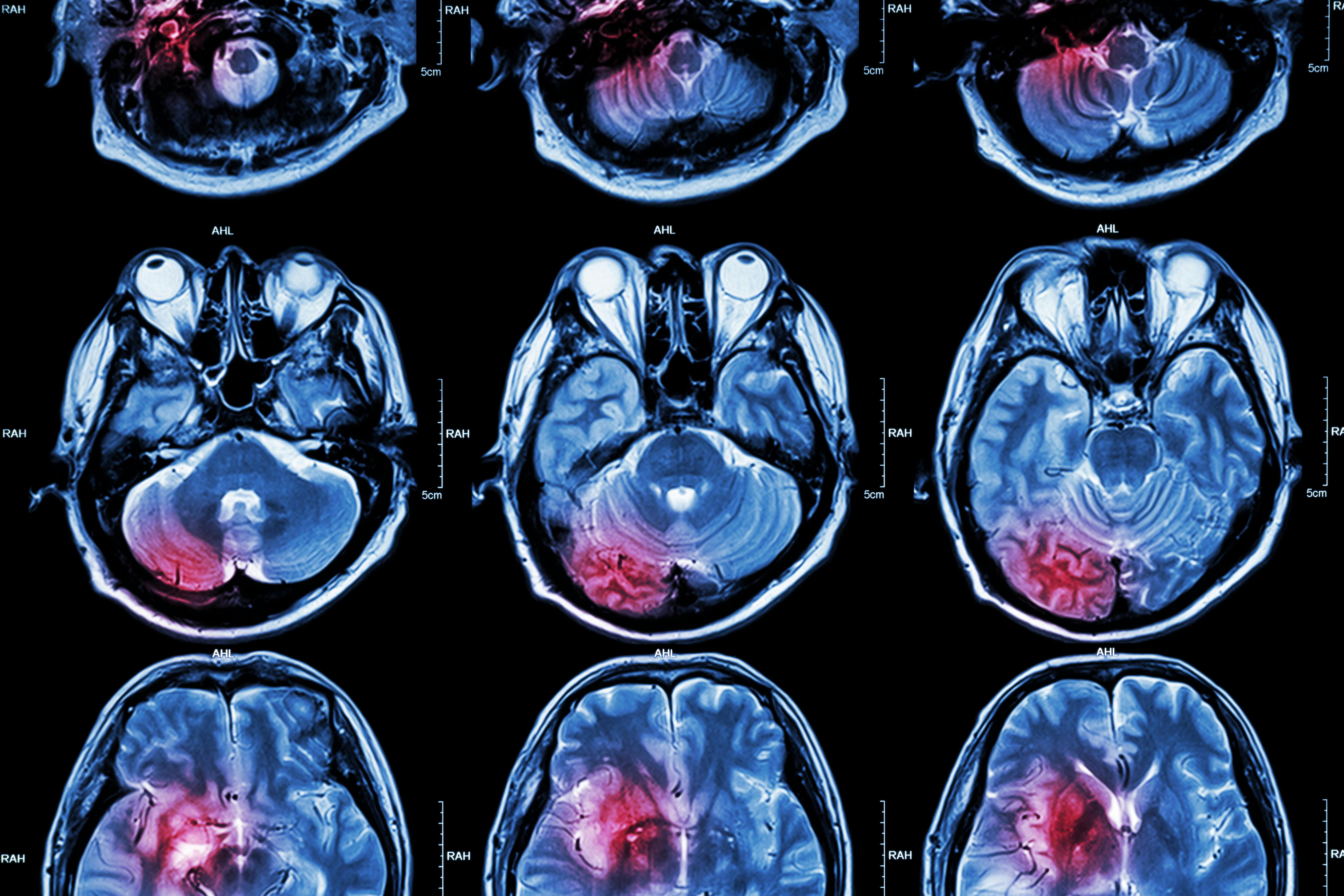 6a3d721e553c5e5a0673934c Tumor