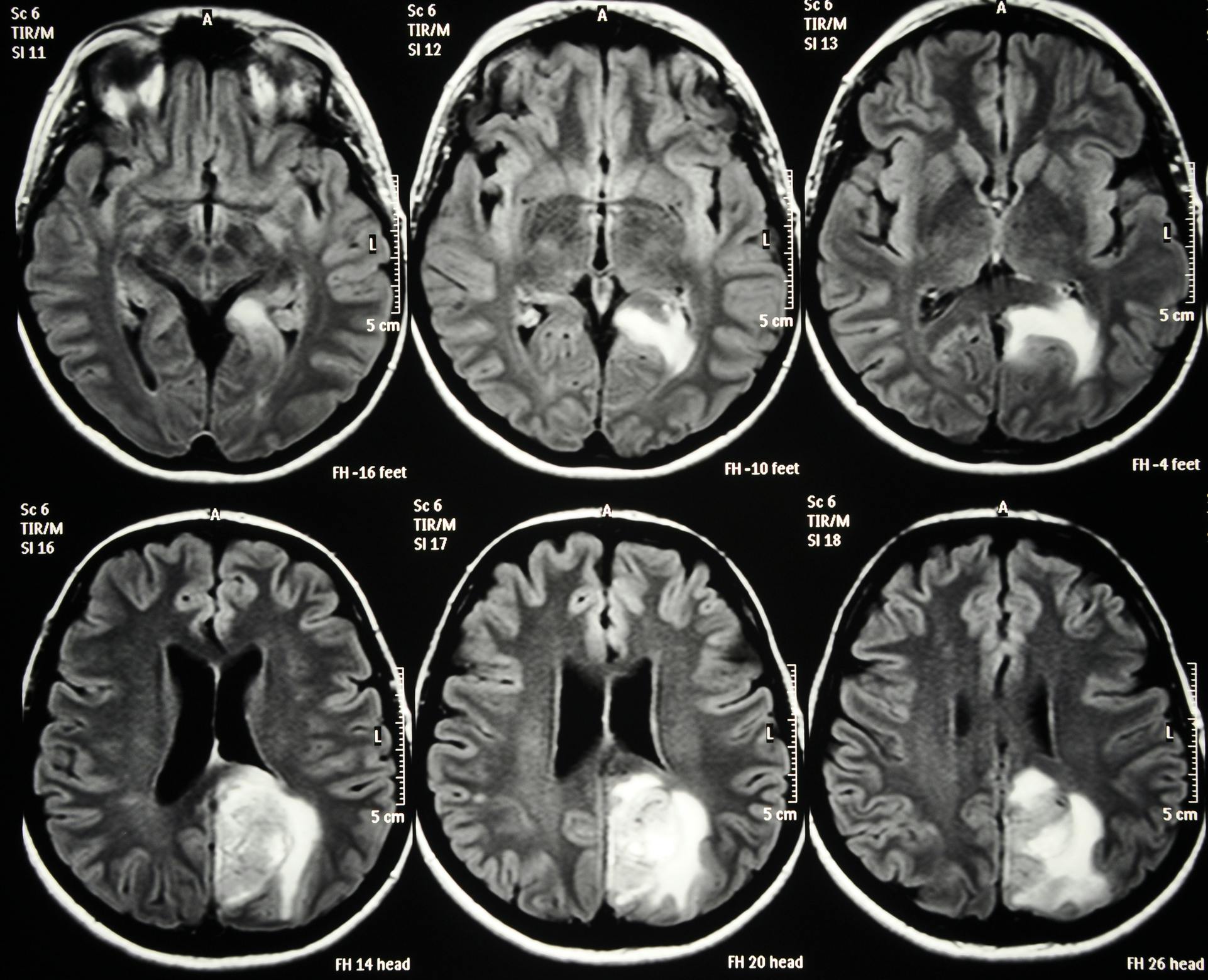 6a68f870b19db4e33e038bee Glioblastoma