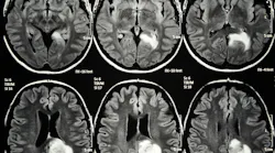 glioblastoma