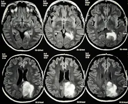 6a68f870b19db4e33e038bee Glioblastoma