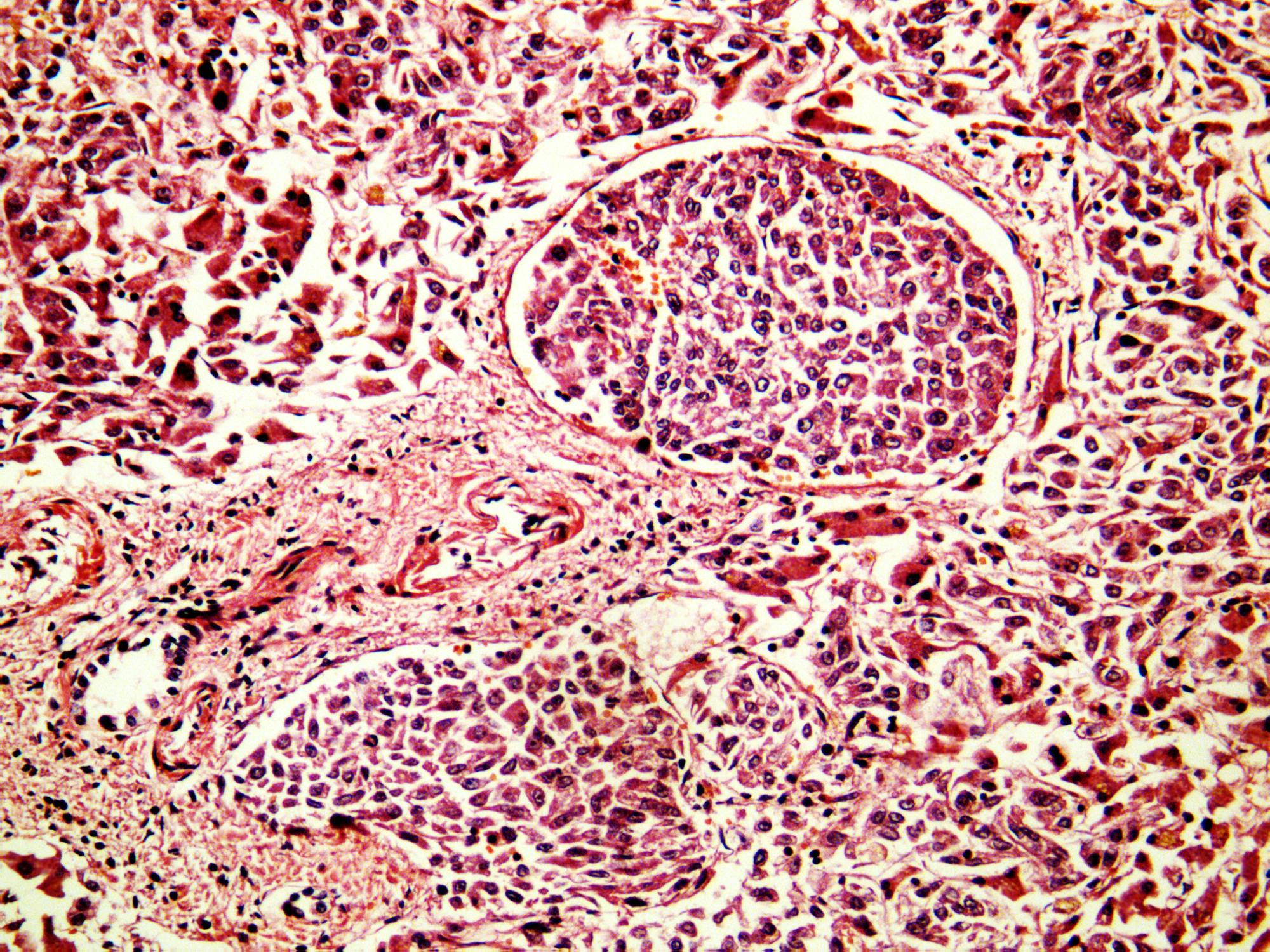 6a7a22e124811ceb497f05a5 Squamous Cell Carcinoma