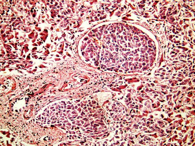 6a7a22e124811ceb497f05a5 Squamous Cell Carcinoma