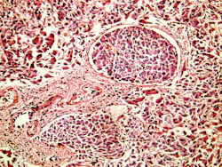 6a7a22e124811ceb497f05a5 Squamous Cell Carcinoma